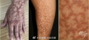 热闻|打工人需警惕！女子长期把电脑放腿上办公，致皮肤出现蟒蛇纹 ...